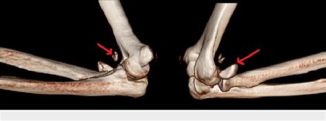 Figure 3 From Use Of Endobutton For Small Avulsion Fracture Of Coronoid In The Terrible Triad Of