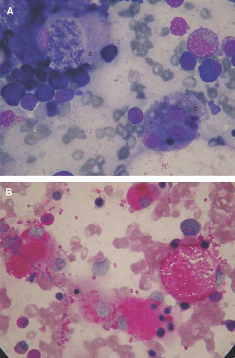 Figure From Hemophagocytic Syndrome In A Patient With Acquired