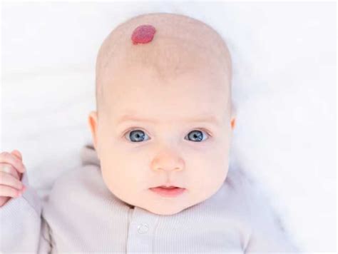 Tratamiento De Hemangiomas Infantiles Unidad De Láser En Cdi