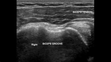 Shoulder Normal And Pathology Internet Book Of Msk Ultrasound