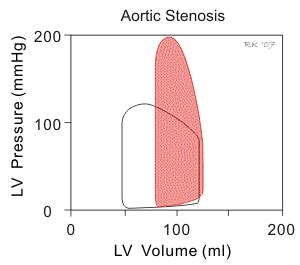 Cv Physiology Aortic Stenosis Aortic Stenosis Stenosis Physiology