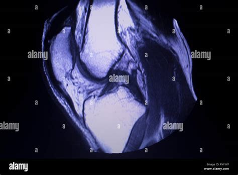 Im Genes Por Resonancia Magn Tica Irm De La Rodilla Cuerno Posterior