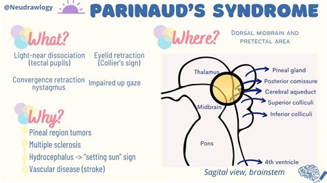 Parinaud S Syndrome