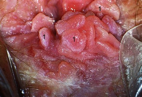 Perianal And Anal Intraepithelial Neoplasia Obgyn Key