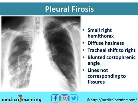 Pleural Firosis Medical Radiography Radiology Imaging Radiology