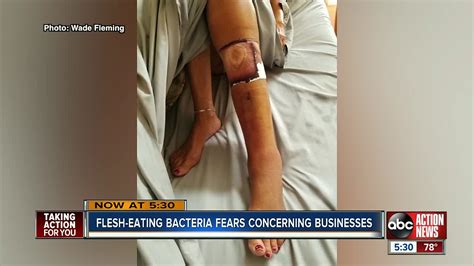 How You Can Prevent Getting Flesh Eating Bacteria