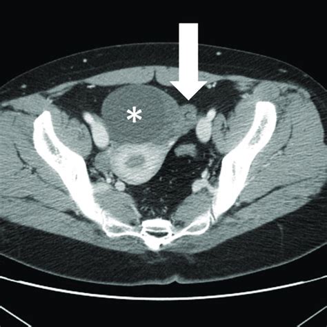 Pdf Ct Findings Of Adnexal Torsion A Matched Case Control Study