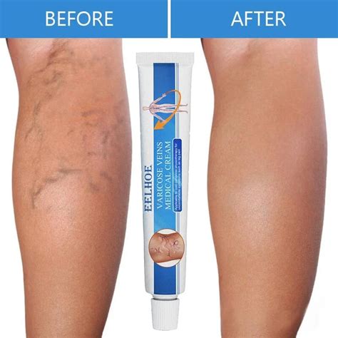 Herbal Varicose Veins Treatment Cream Relieve Tired Legs Dilated