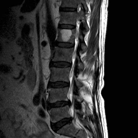 Vertebral Haemangioma Radiology Reference Article