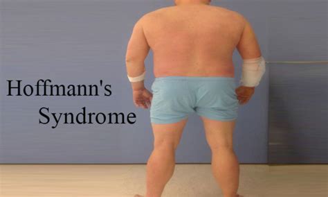 Rare case of Hoffmann's syndrome necessitating forearm fasciotomy: a case report