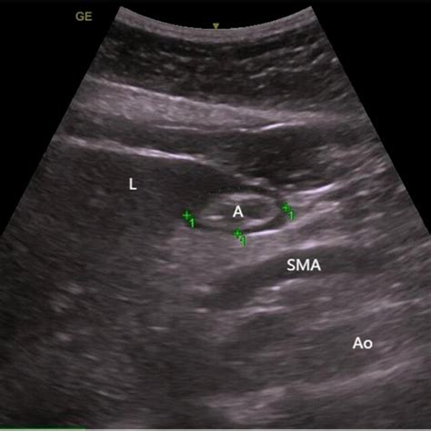 Ultrasonographic Image Of The Gastric Antrum A Gastric Antrum L Download Scientific Diagram