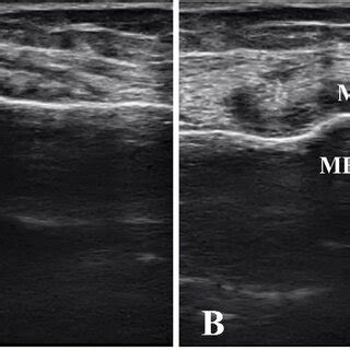 Ultrasonographic Findings In Knee Osteoarthritis A Comparative Study