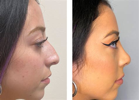 Who Is The Best Rhinoplasty Surgeon In Iran Persiamedtours