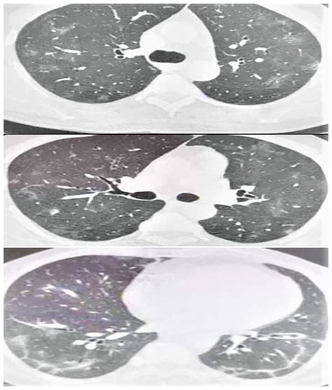 The Ct Scan Of The Thorax Showed Ground Glass Opacities And Download Scientific Diagram