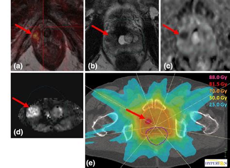 Multi Parametric Pet Mri Of A Patient With Prostate Cancer Combined