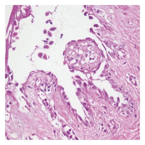 Suprabasal Epidermal Acantholysis And Cleft Containing Inflammatory