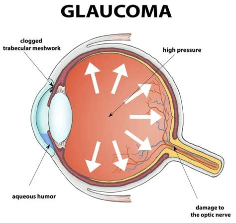 Glaucoma Treatment Ophthalmology Clinic In Dubai Drhc