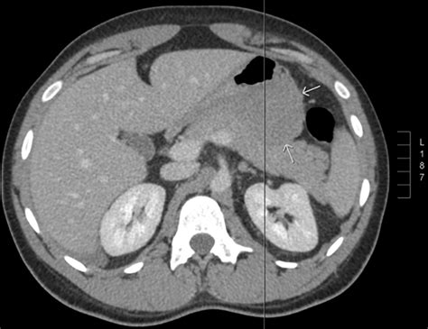 Frontiers Case Report Desmoid Fibromatosis Diagnosed In A Year