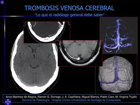 La Trombosis Venosa Cerebral Explicada En Lenguaje Simple Nbkomputer