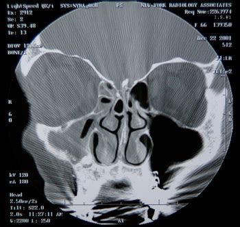 Sinusitis Treatment and Surgery NYC | Case Studies