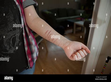 Self Harm Stockfotos Self Harm Bilder Alamy