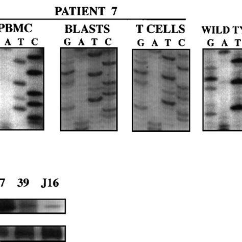 Mutation Analysis Of Patient 7 A Heterozygous Germline Mutation In