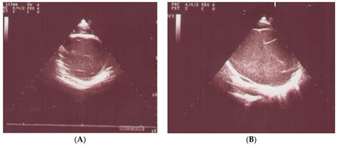 Pediatric Reports Free Full Text Large Congenital Pericardial Cyst