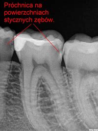 Co to jest próchnica zębów Stomatologia Adentis