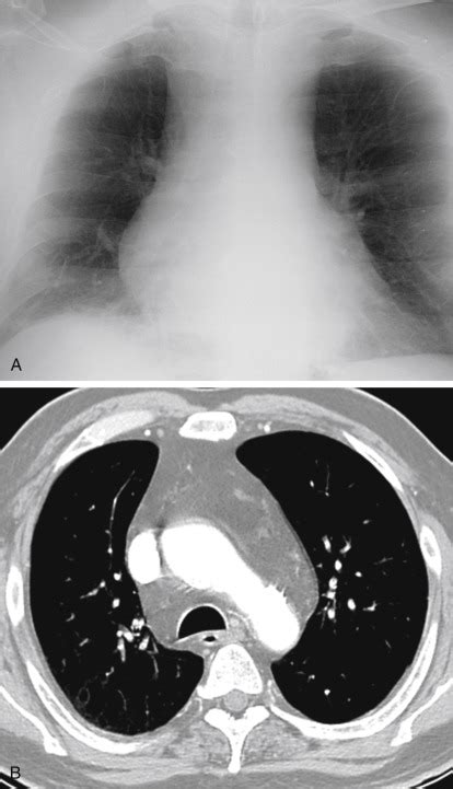 Widening Of The Mediastinum Radiology Key