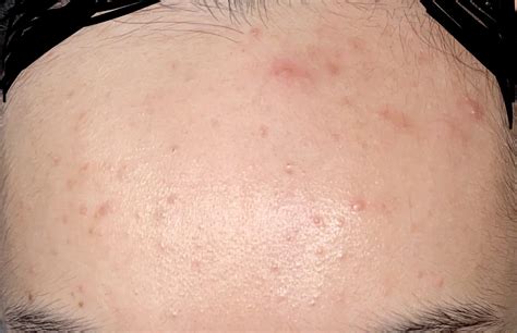 [acne] Help Forehead Acne And Closed Comedones For 5years Tried Nearly Everything More Below