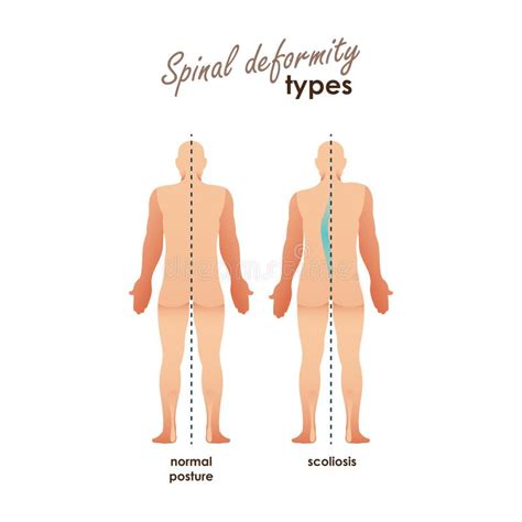 Diseases Of The Spine Scoliosis Lordosis Kyphosis Body Posture