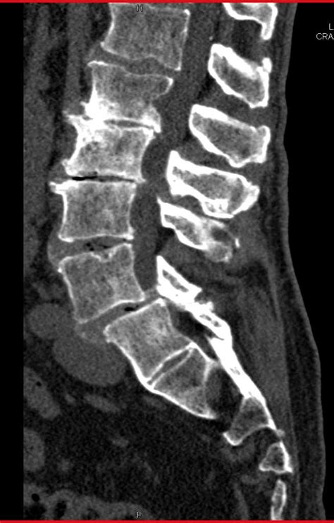 Degenerative Lumbar Spine X Ray