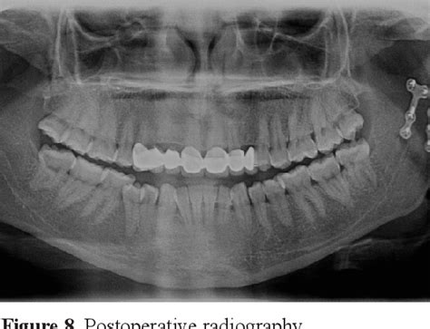 Figure From Open Reduction Of Mandibular Condyle Neck Fractures Case