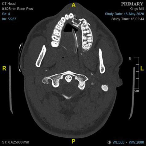 Ct Imaging Showing The Maxillofacial Injury Download Scientific Diagram