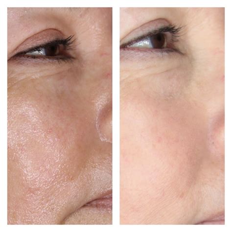 Microneedling - Beautydermapro Organic Permanent Makeup & Skin Care