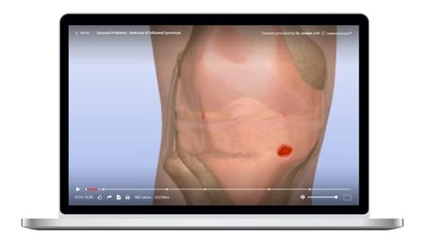 Synovial Problems - Removal of Inflamed Synovium Animation – Understand.com