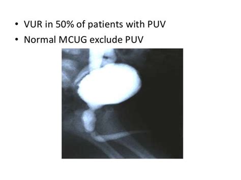 Etiopathogenesis Evaluation And Management Of Posterior Urethral Valve