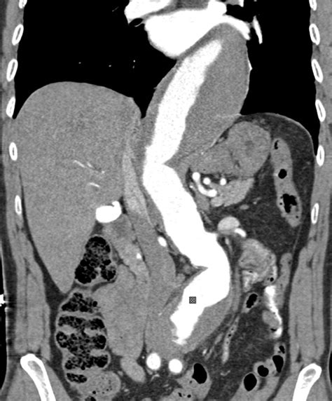 Abdominal Aortic Aneurysms Revisited MDCT With Multiplanar