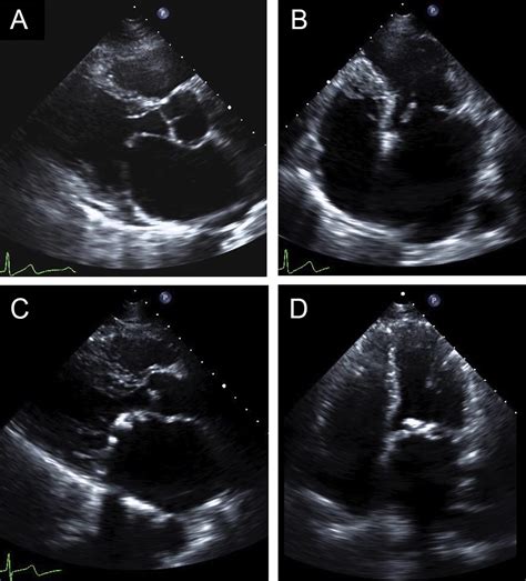 Advances In Rheumatic Mitral Stenosis Echocardiographic