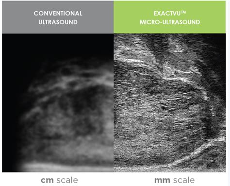 Ai And Micro Ultrasound Team Up To Tackle Prostate Cancer