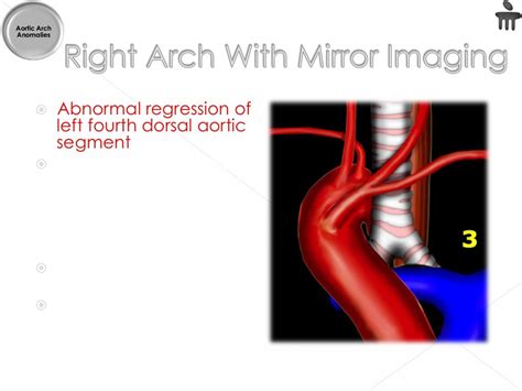 Aortic arch anomalies