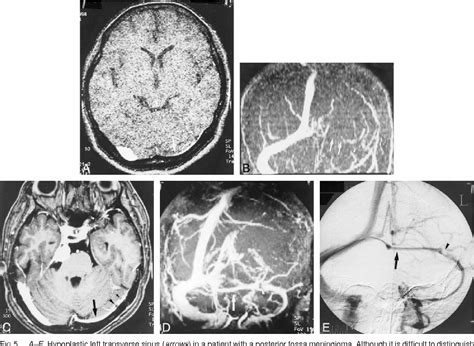 Figure From Evaluation Of The Intracranial Dural Sinuses With A D