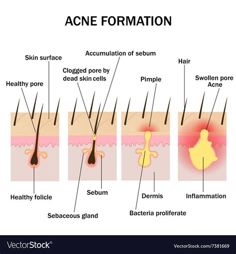 Formation Of Acne Royalty Free Vector Image Vectorstock