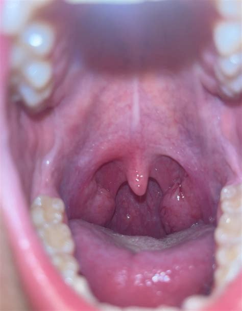 Do my tonsils look swollen lmao : r/DiagnoseMe