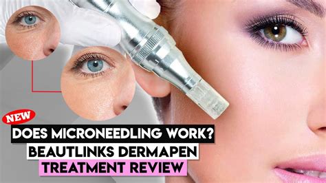 Everything You Need To Know About Skin Needling