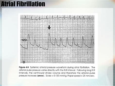 PPT Hemodynamic Monitoring In The CCU PowerPoint Presentation Free