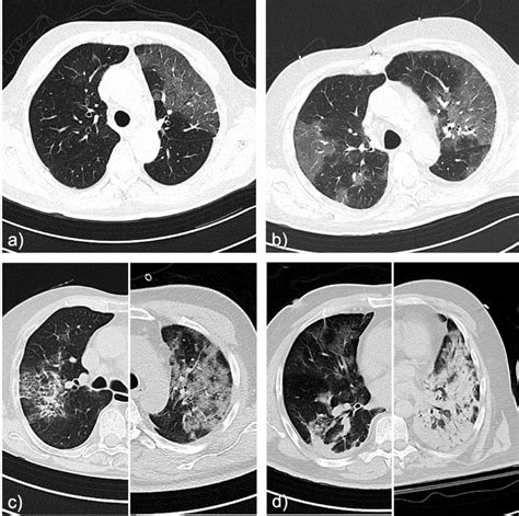 Examples Of CT Patterns A Normal Pulmonary Parenchyma Severity Score