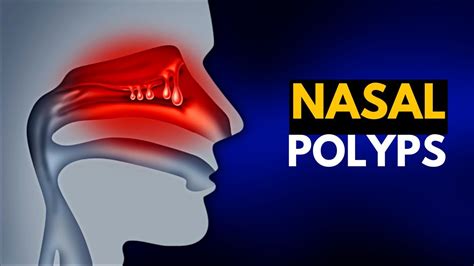 Nasal Polyps 10 Symptoms Of Nasal Polyps