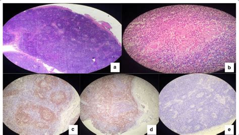 Lymph Node Biopsy Presenting The General Appearance Of Castlemans Download Scientific Diagram