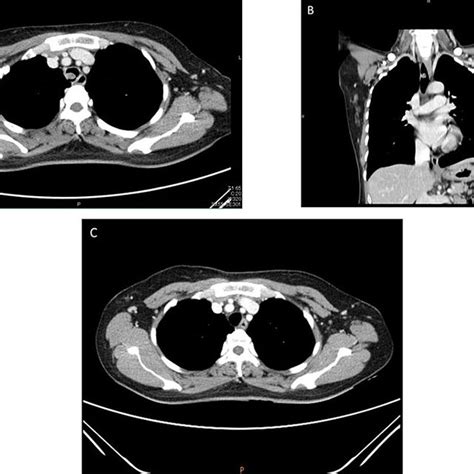 A And B Computerized Tomography Chest Scan Demonstrating A 08 Cm Download Scientific Diagram